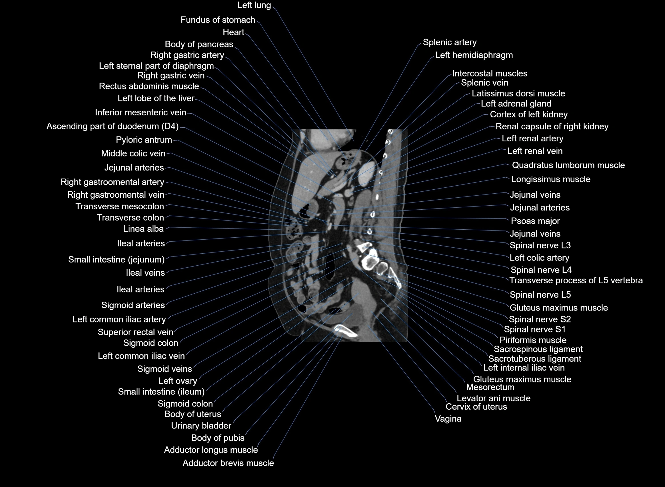 CT Abdomen sagittal cross sectional anatomy labelled radiology image -00051.webp